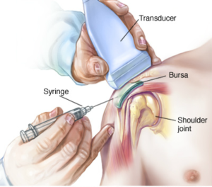 Intra articular steroid injection